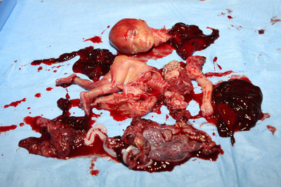 Efekt aborcji - morderstwo dziecka